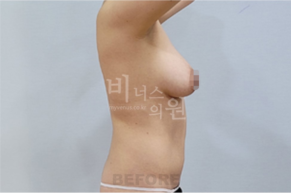 유방하수 지방흡입 수술 전 측면 2 (팔 올림)