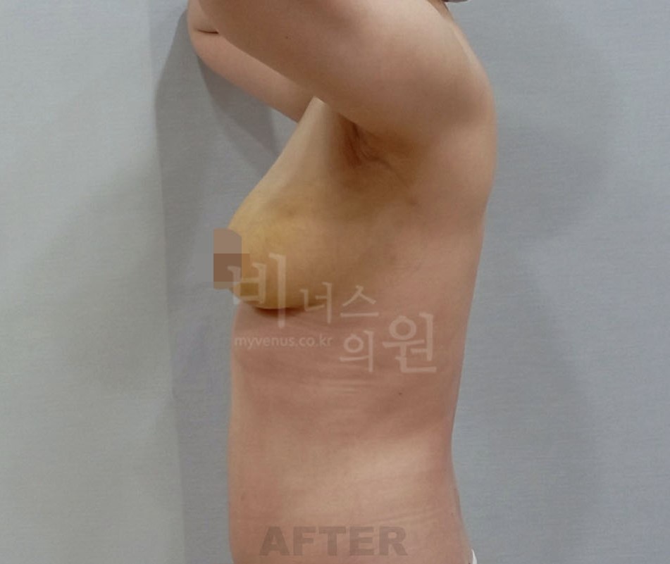 유방하수 표층 지방흡입 수술 후 측면 첫 번째 방향