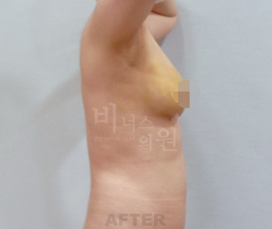 유방하수 표층 지방흡입 수술 후 측면 반대쪽 방향
