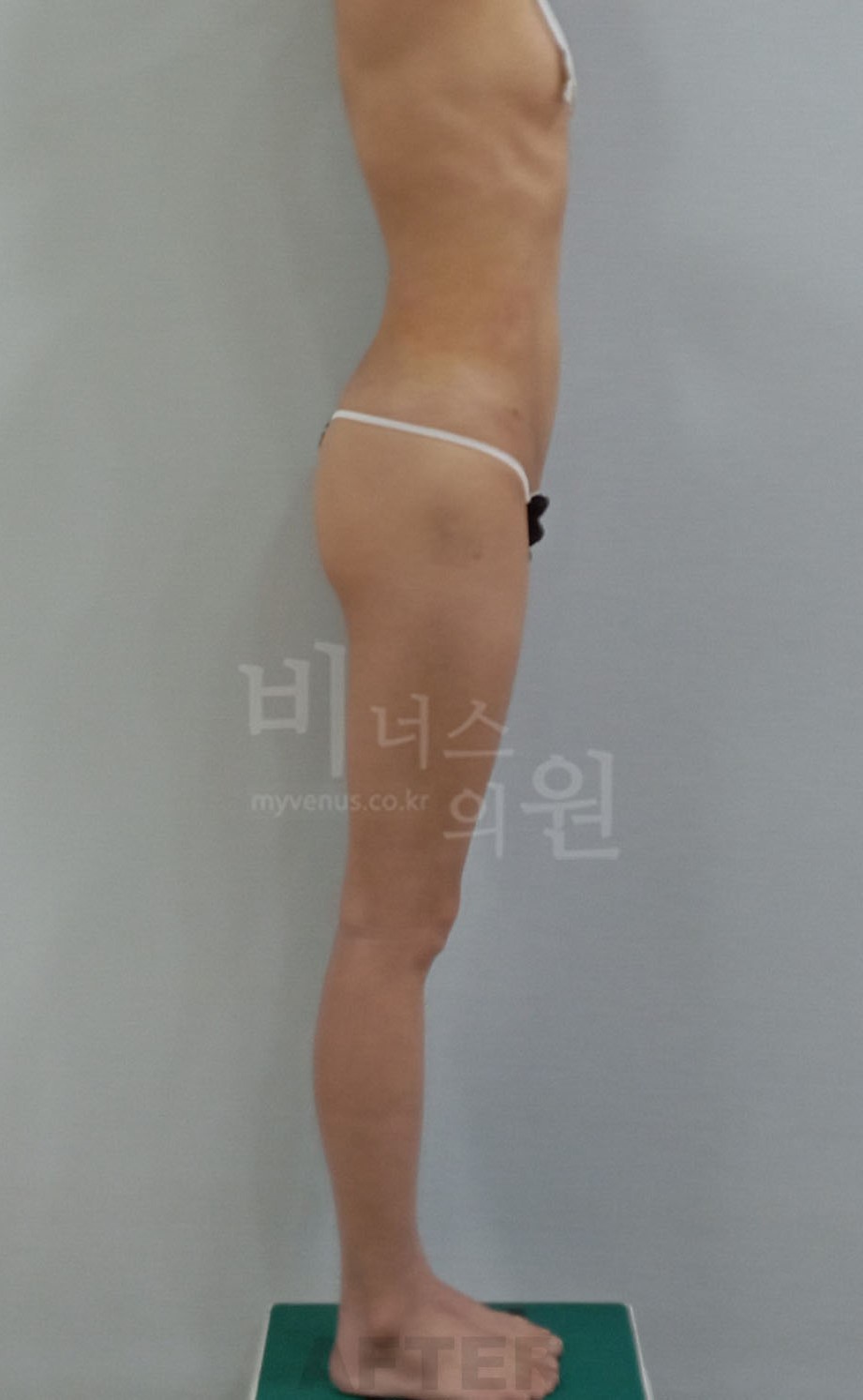 허리 지방흡입 수술 후 반대쪽 측면