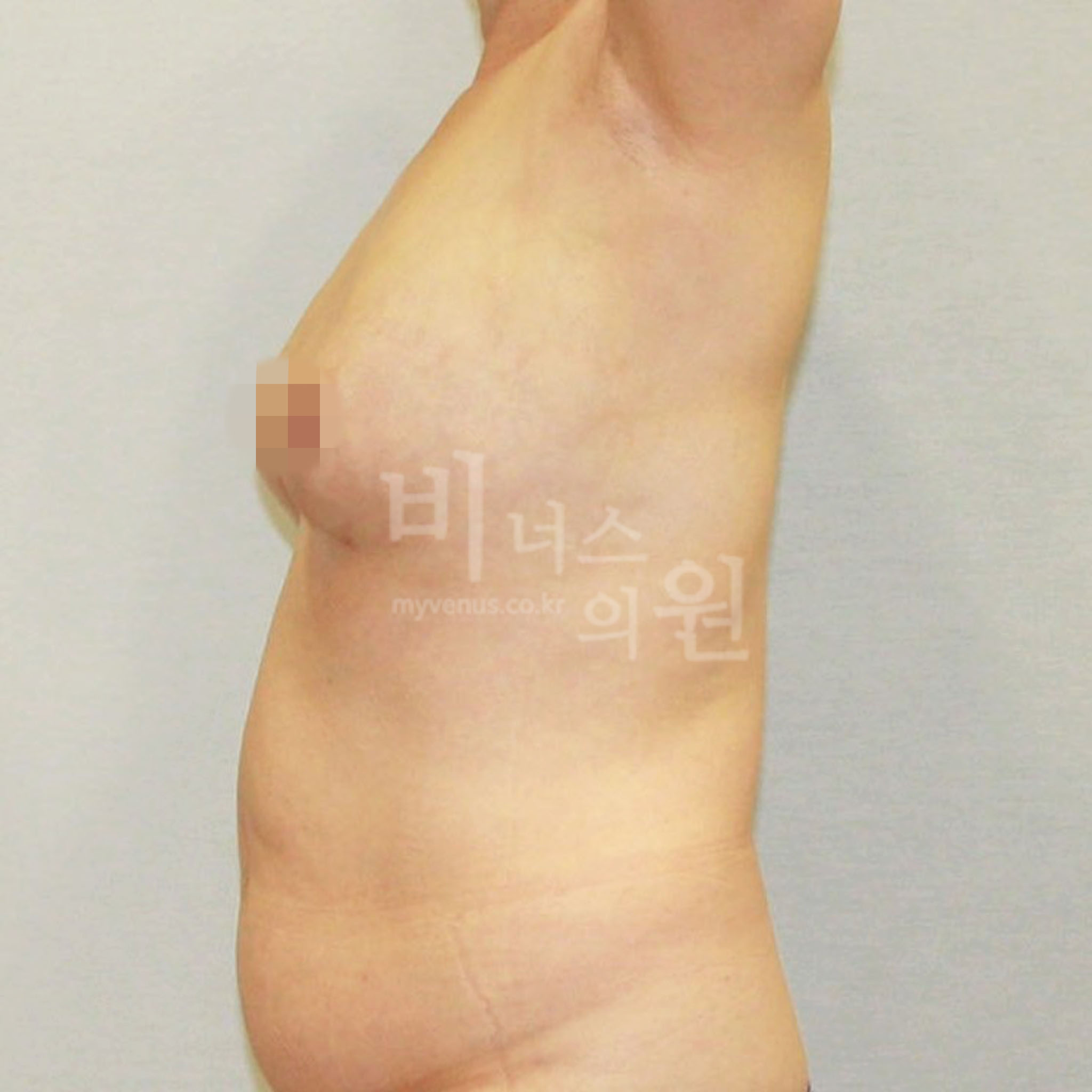 유방 지방흡입 수술 후 측면 사진