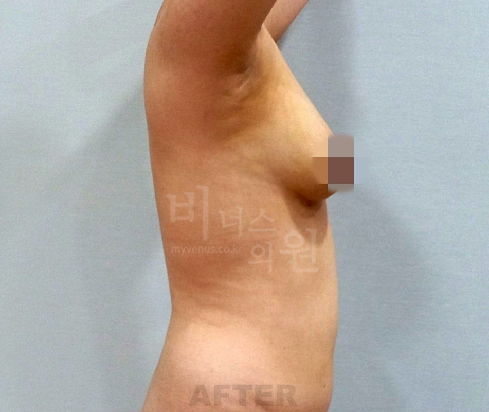 유방하수 표층 지방흡입 수술 후 좌측면
