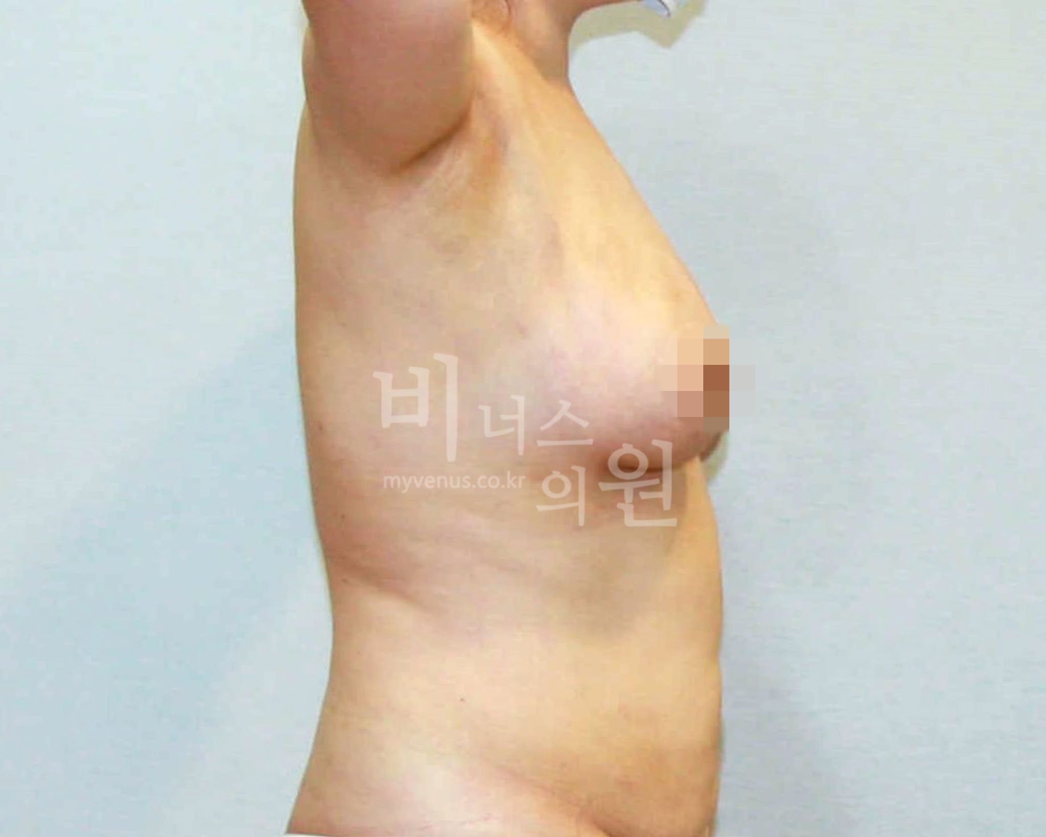 유방하수 표층 지방흡입 수술 후 측면 사진