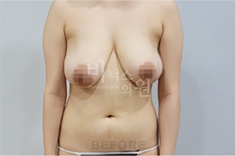 2025년 촬영 유방 표층 지방흡입 수술 전 정면(팔 내림)