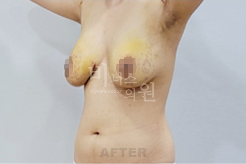 2025년 촬영 유방 표층 지방흡입 수술 후 좌측 45도 측면