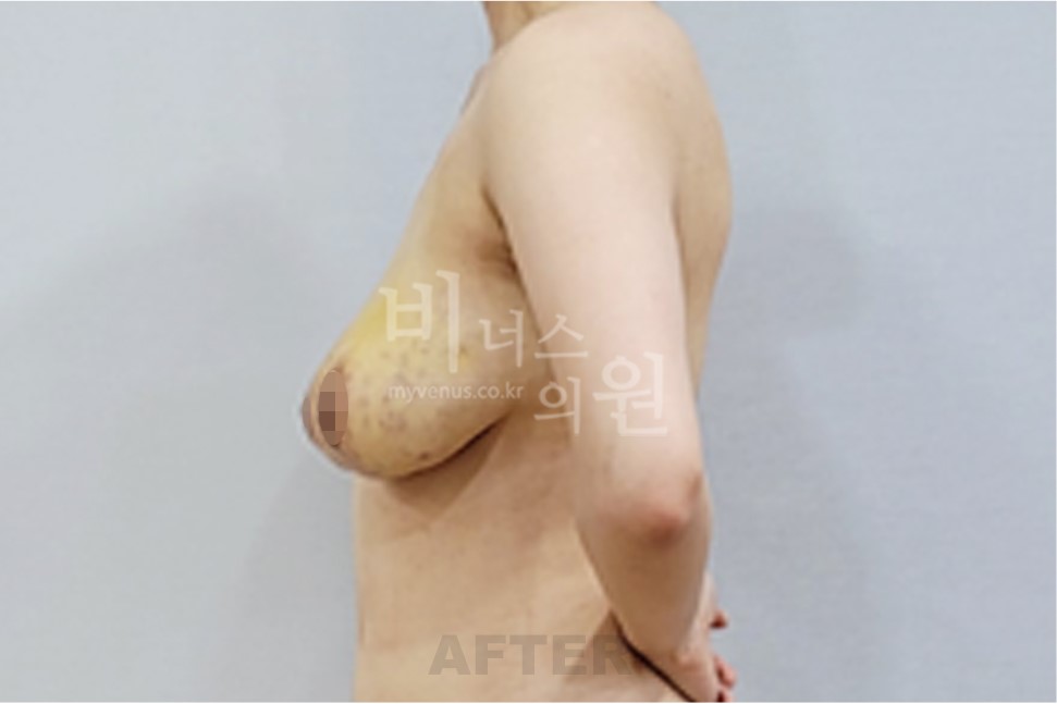 2025년 촬영 유방 표층 지방흡입 수술 후 우측면