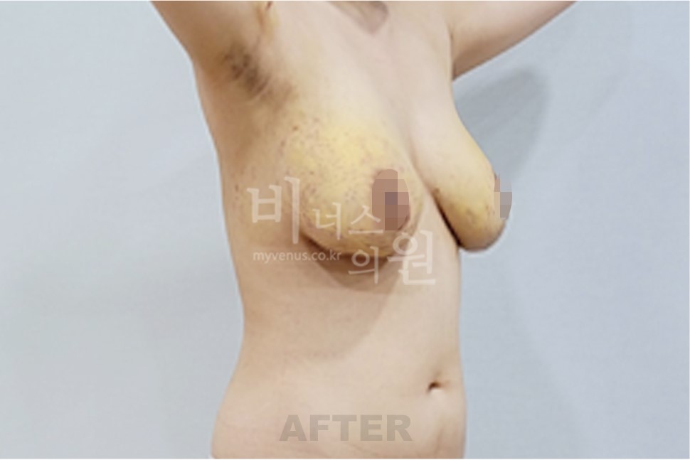 2025년 촬영 유방 표층 지방흡입 수술 후 우측 45도 측면