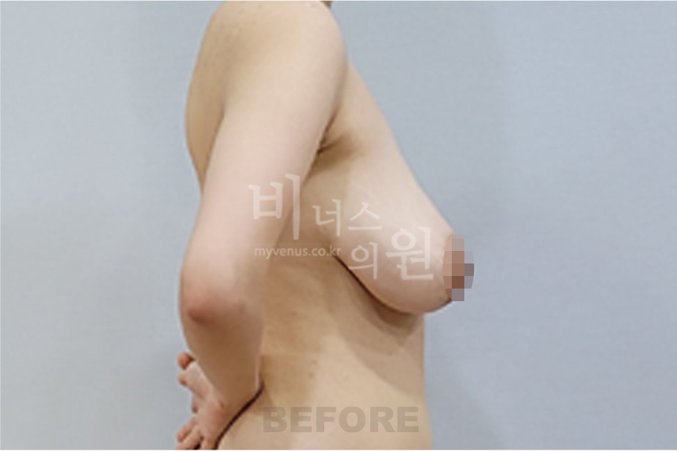 2025년 촬영 유방 표층 지방흡입 수술 전 좌측면