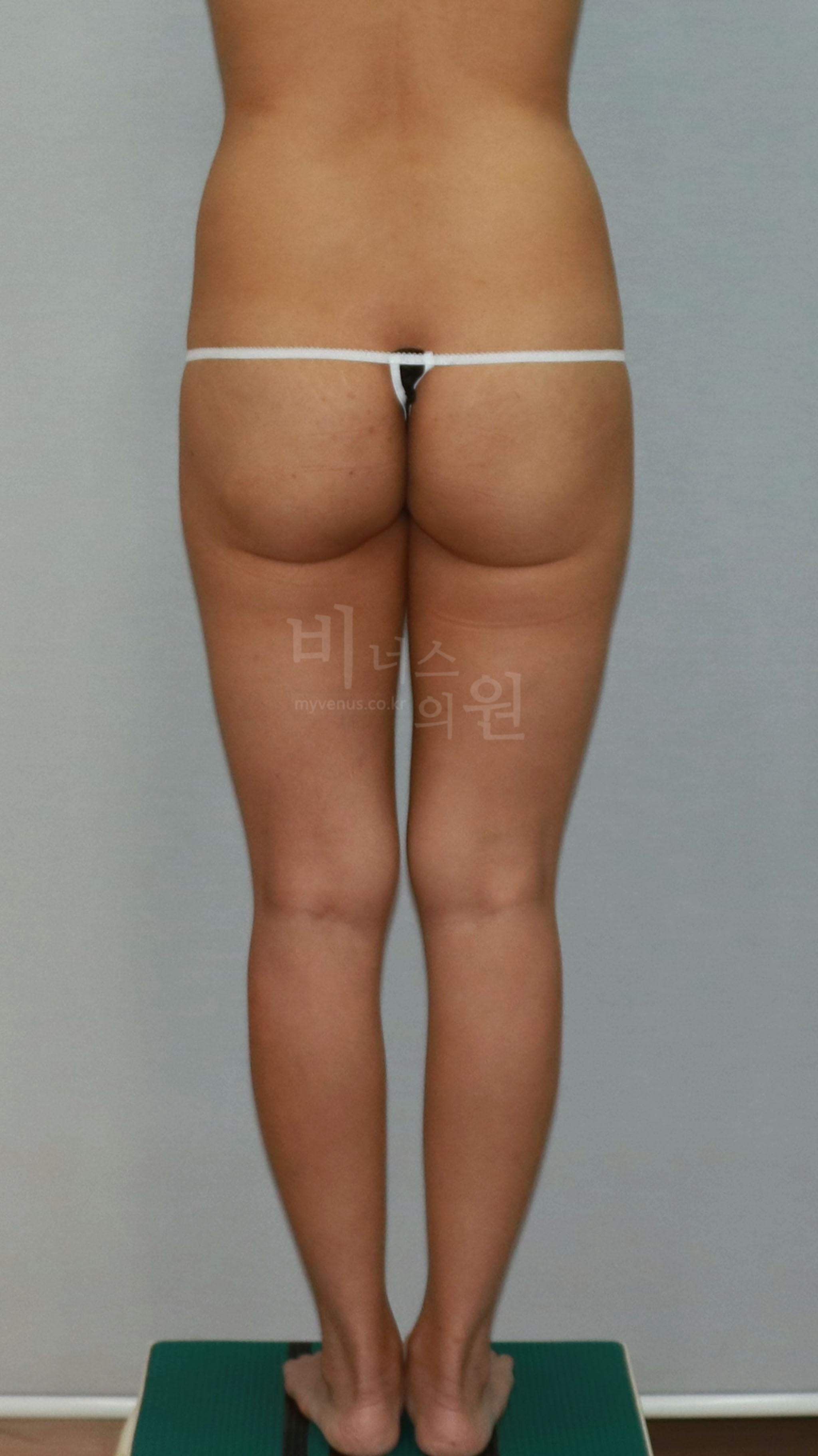 엉덩이축소 지방흡입 수술 전 후면