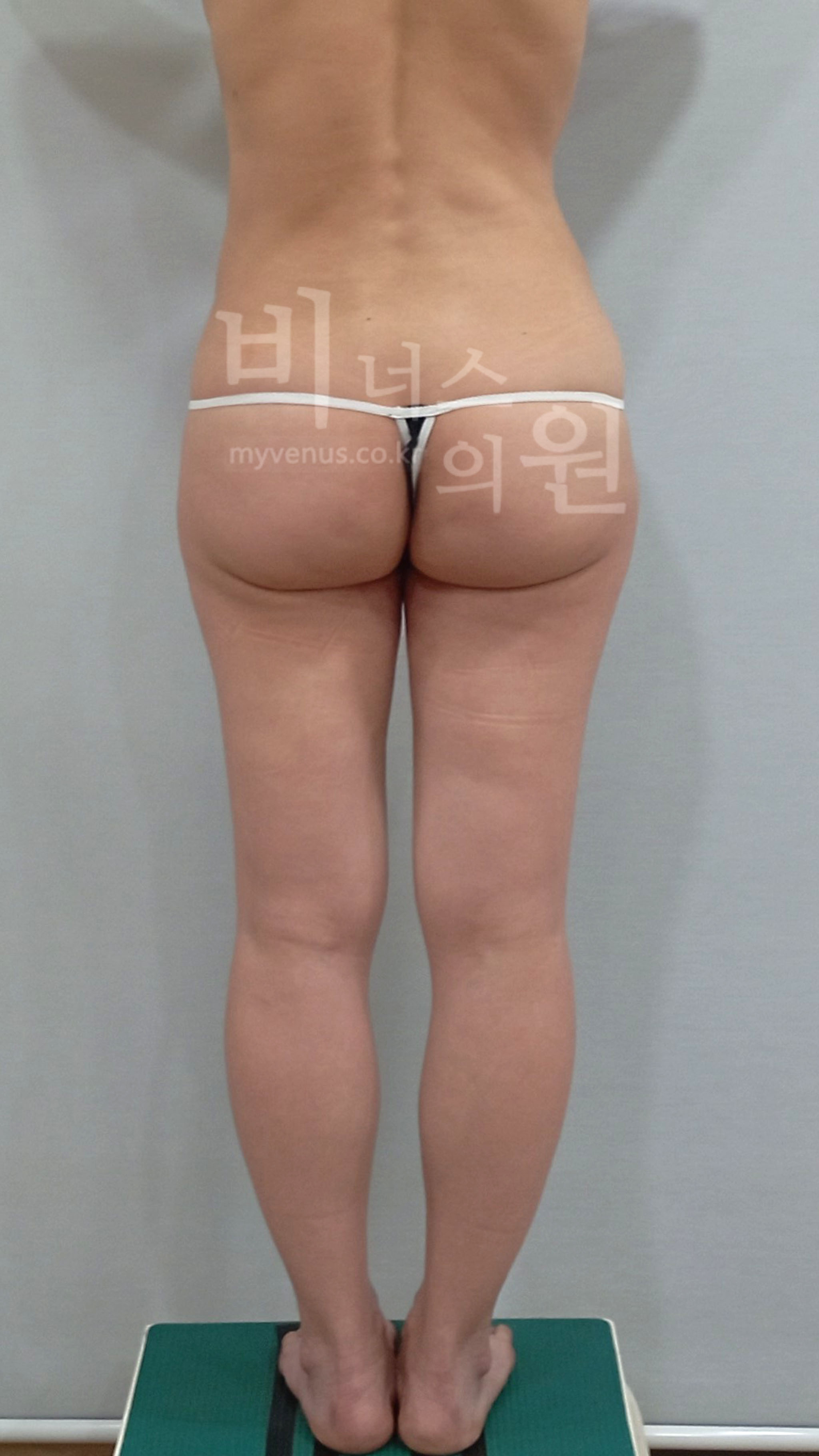엉덩이처짐 표층 지방흡입 수술 전 후면 다리 모음 사진