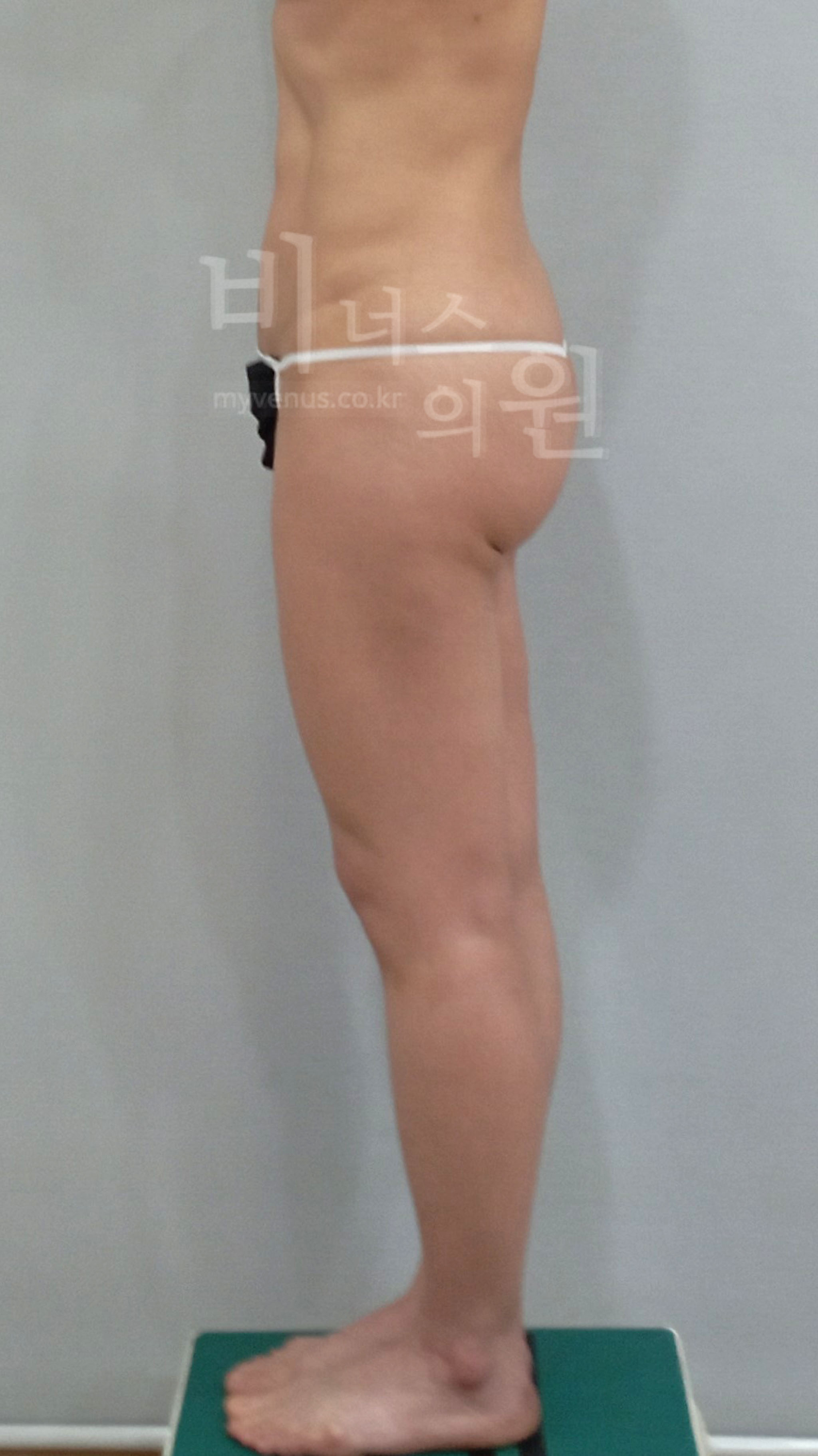 엉덩이처짐 표층 지방흡입 수술 전 측면 사진