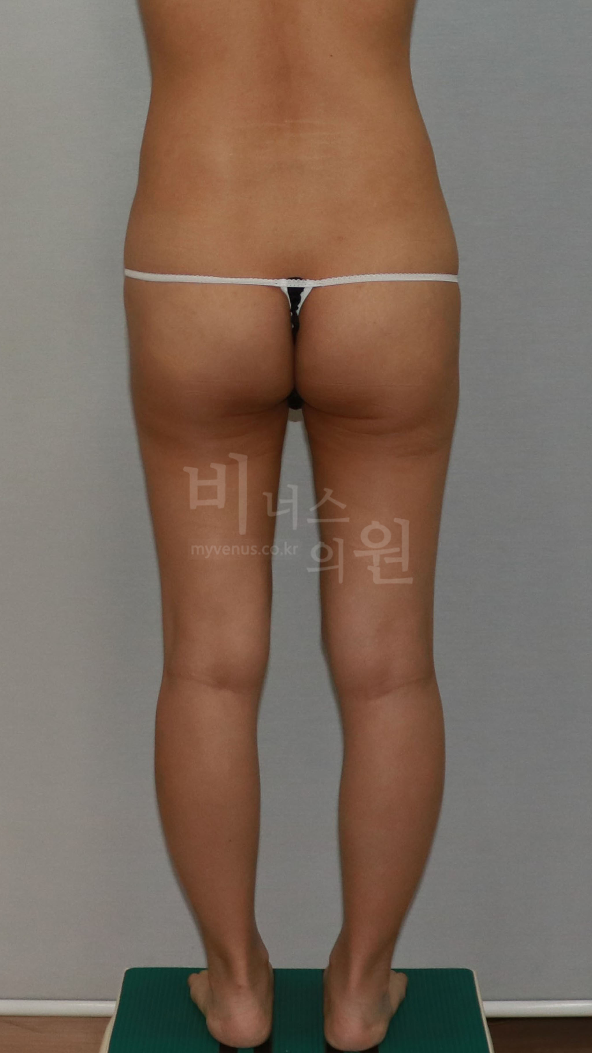 엉덩이 지방흡입 수술 전 후면 사진 1