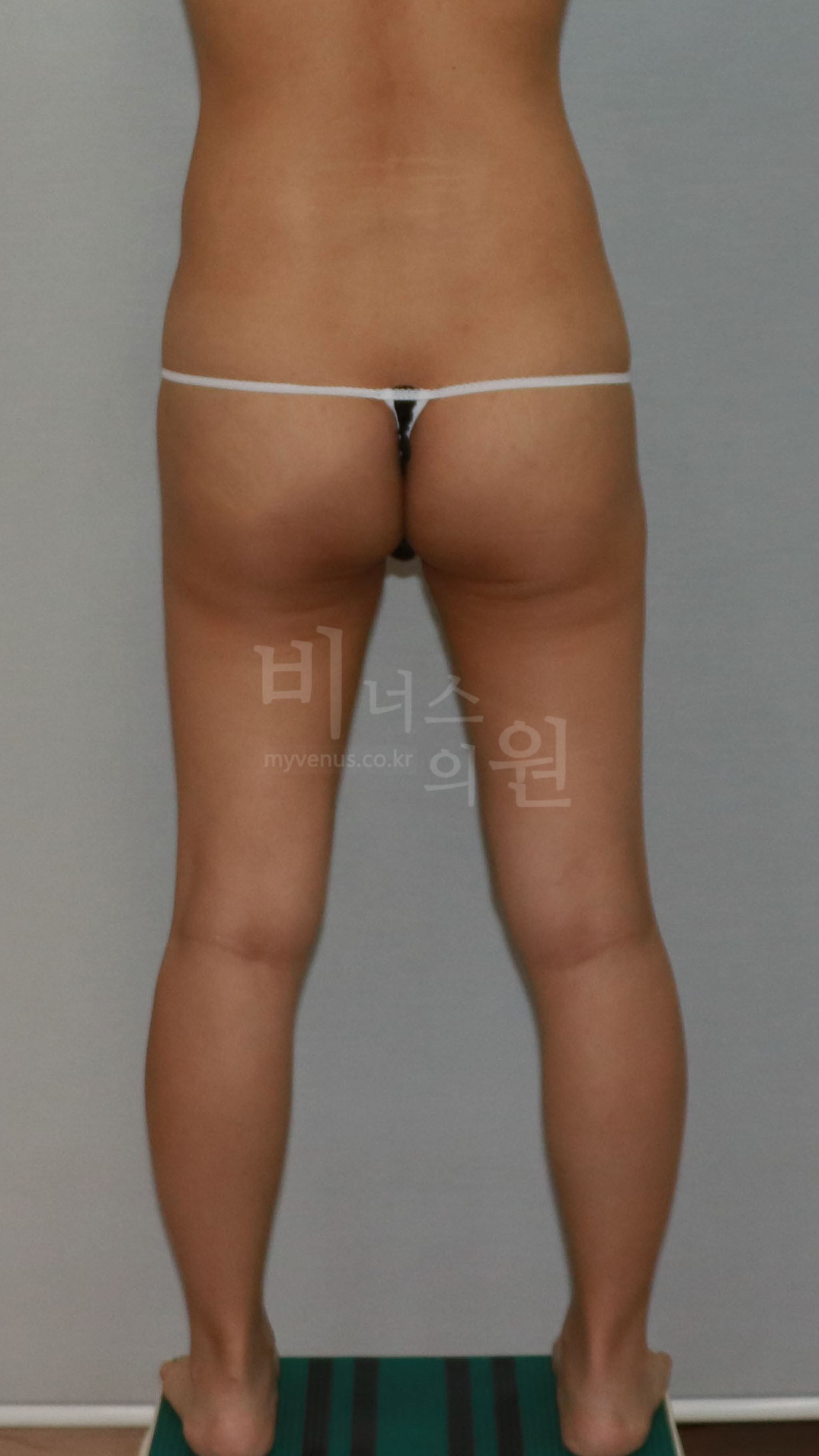 엉덩이 지방흡입 수술 전 후면 사진 2