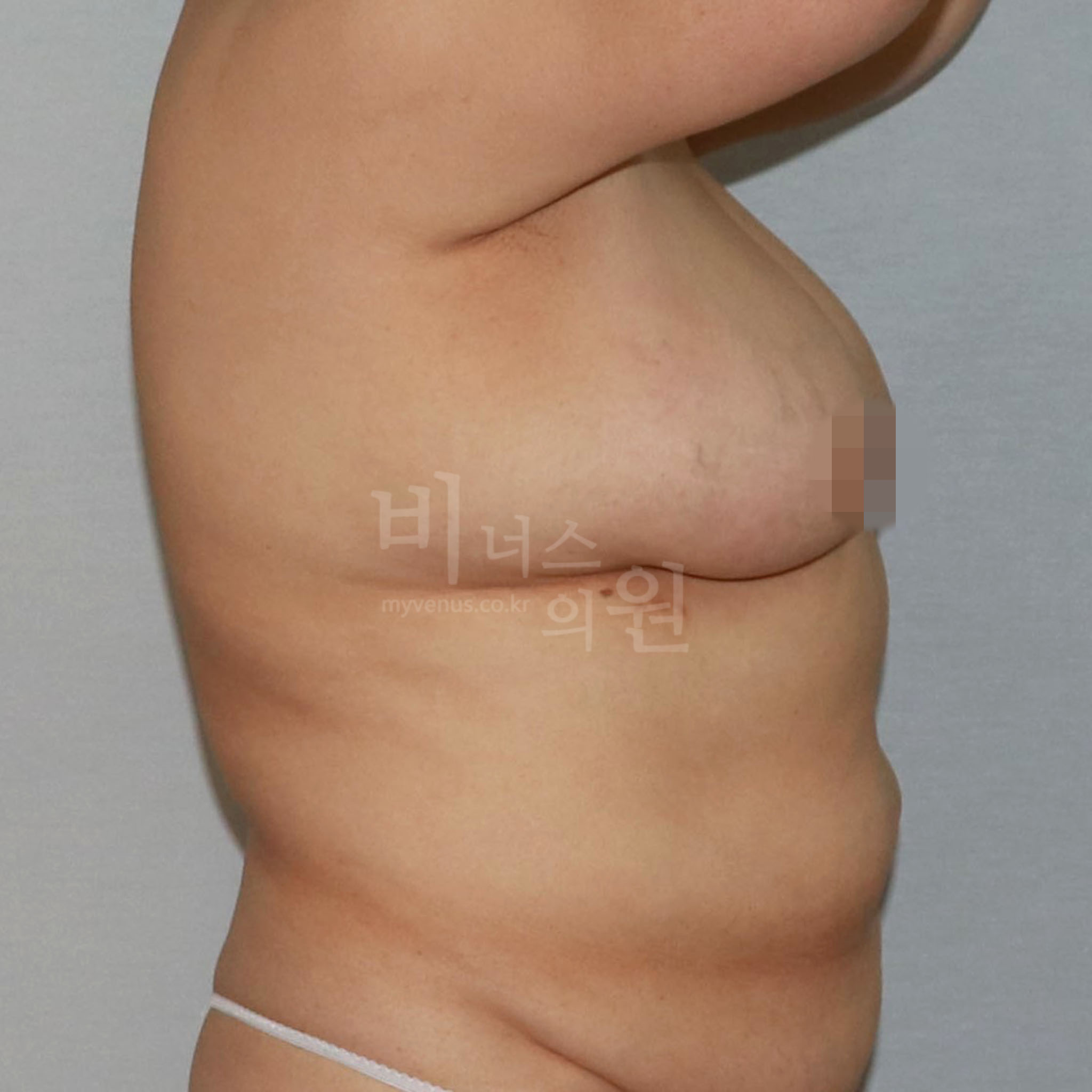 유방하수 표층 지방흡입 전후 참고용 우측면 수술 전 사진 비너스의원
