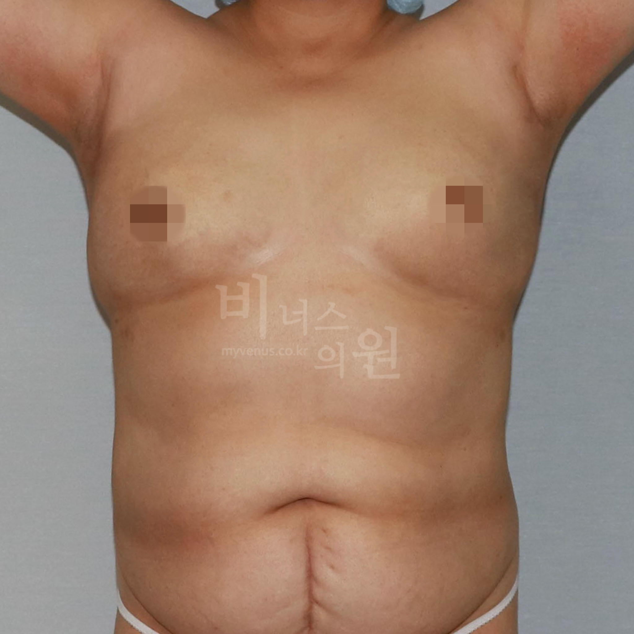 유방하수 표층 지방흡입 전후 참고용 정면 수술 후 사진 비너스의원