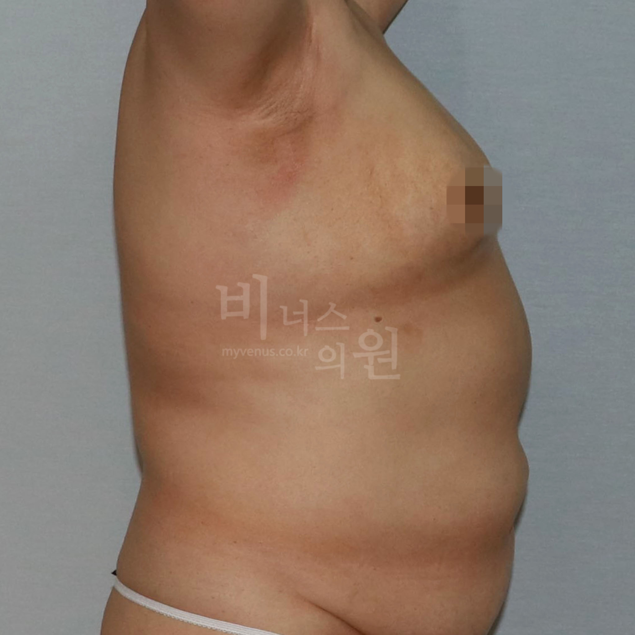 유방하수 표층 지방흡입 전후 참고용 좌측면 수술 후 사진 비너스의원