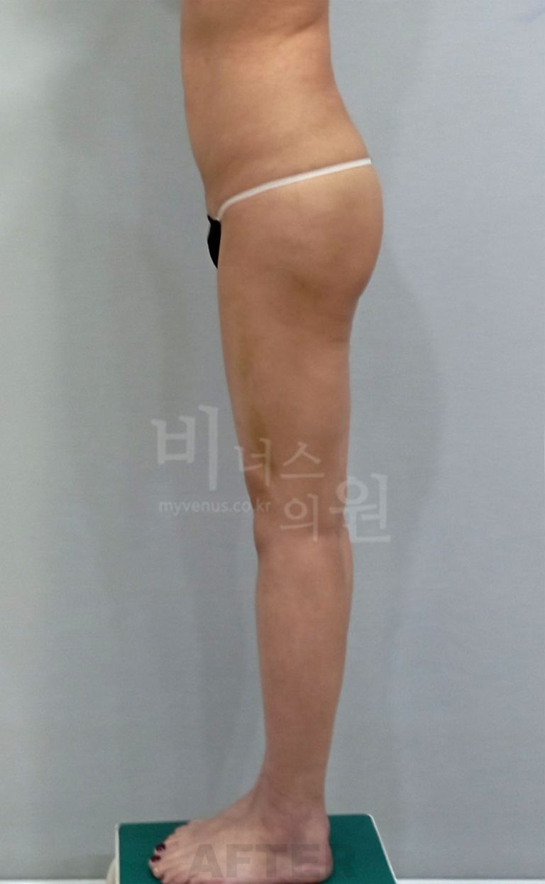 엉덩이축소 지방흡입 수술 후 측면 1 전후사진