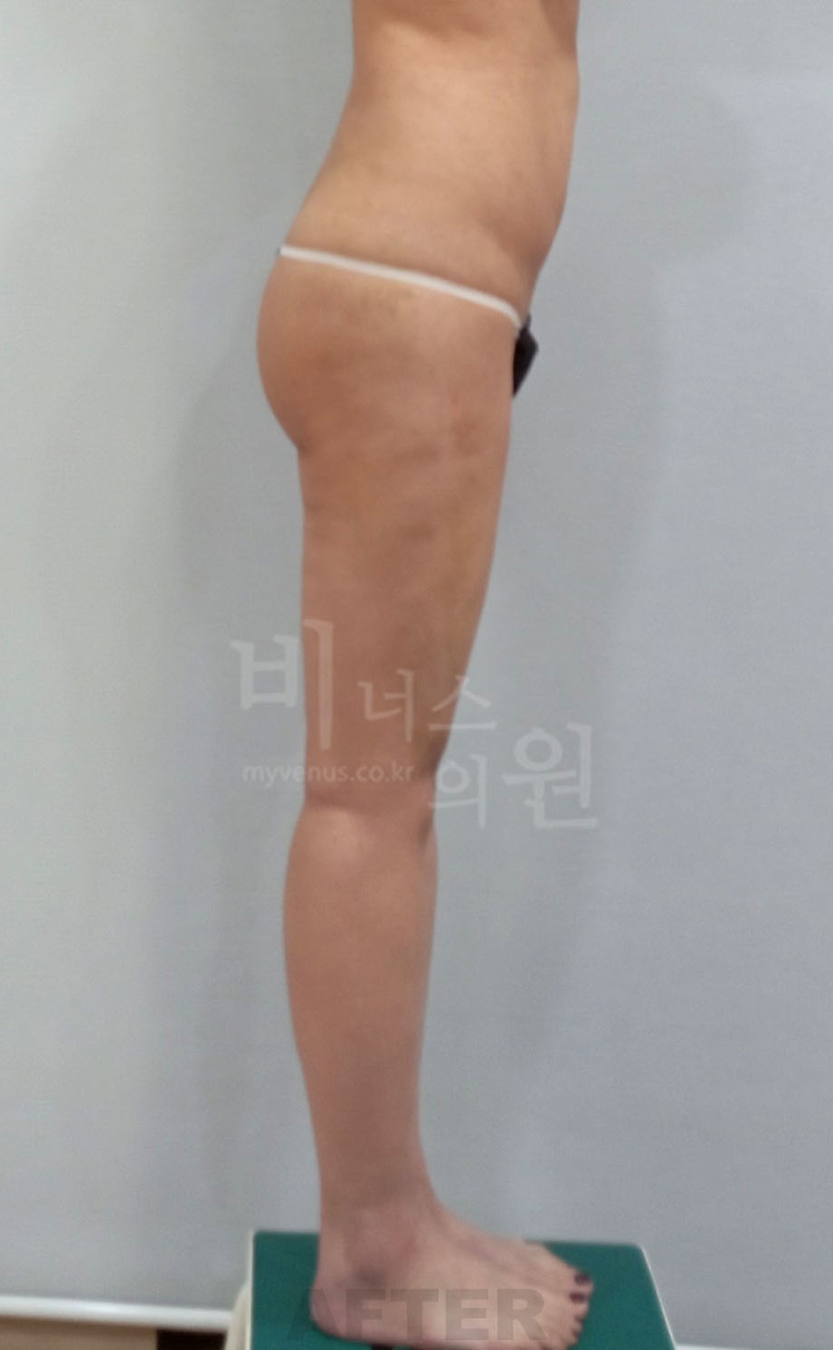 엉덩이축소 지방흡입 수술 후 측면 2 전후사진