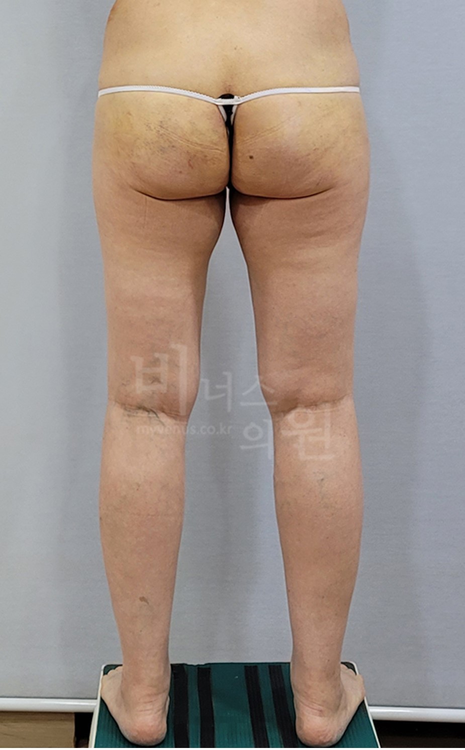 2025년 촬영 엉덩이 지방흡입 수술 후 후면 자세 3 사진