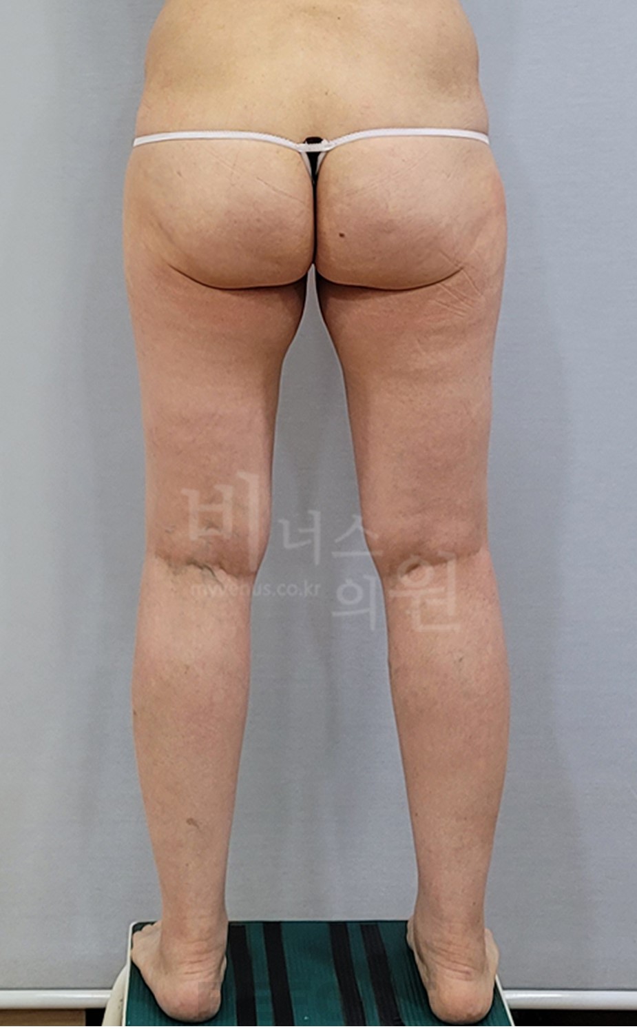 2025년 촬영 엉덩이 지방흡입 수술 전 후면 자세 3 사진