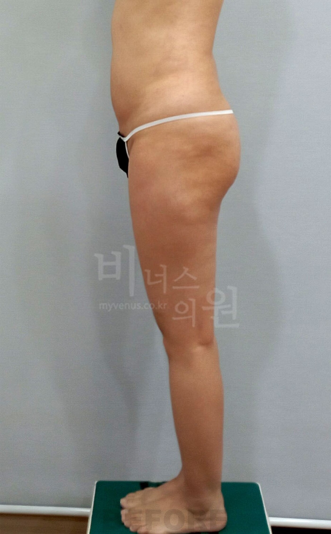 엉덩이축소 지방흡입 수술 전 측면 사진