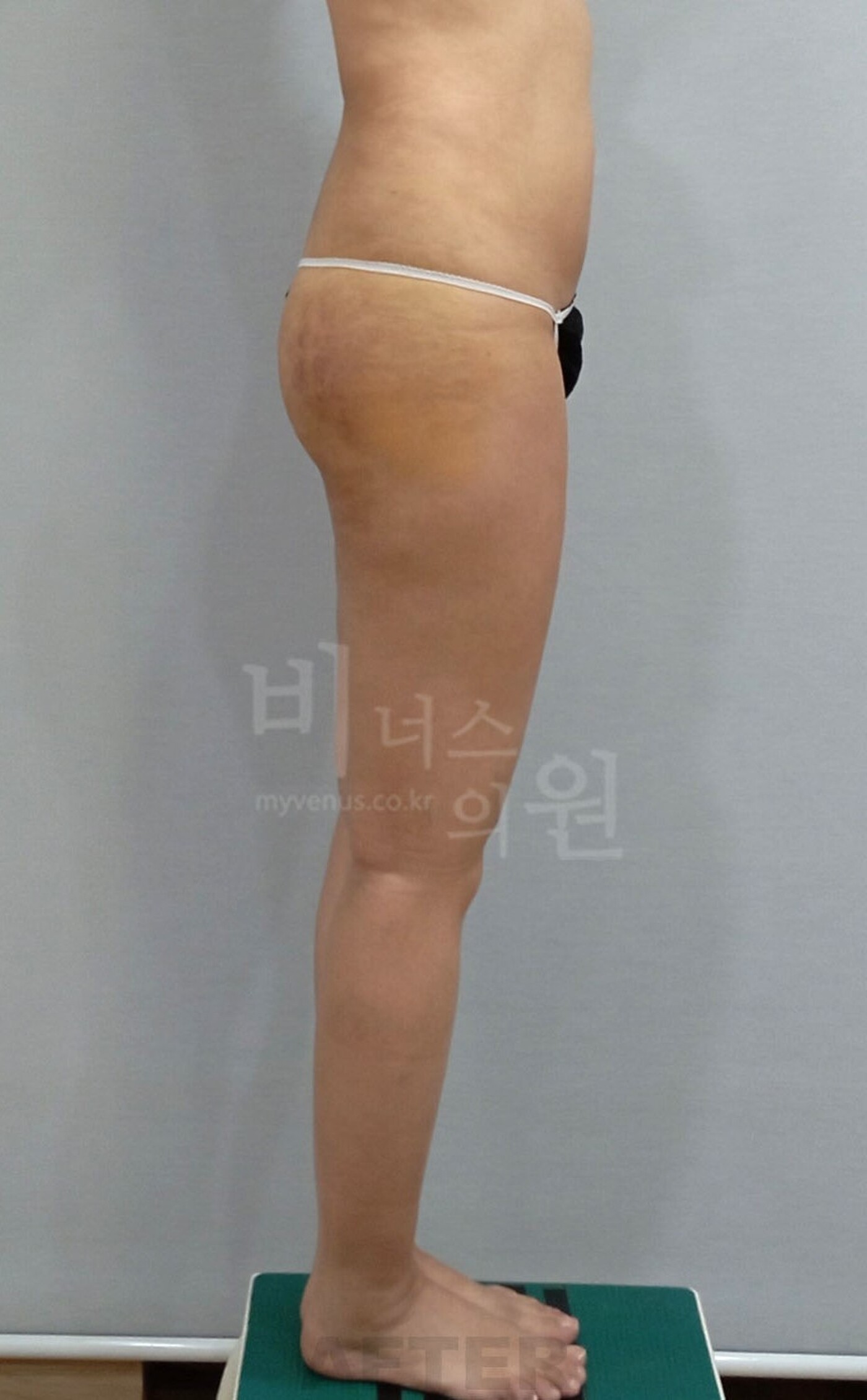 엉덩이축소 지방흡입 수술 후 측면 사진