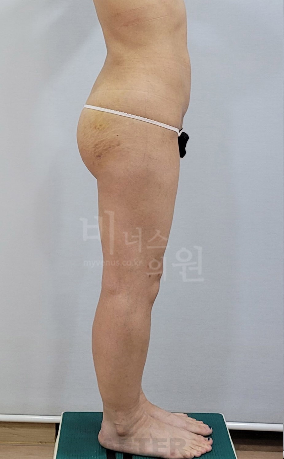 엉덩이축소 지방흡입 수술 후 측면 두 번째 촬영