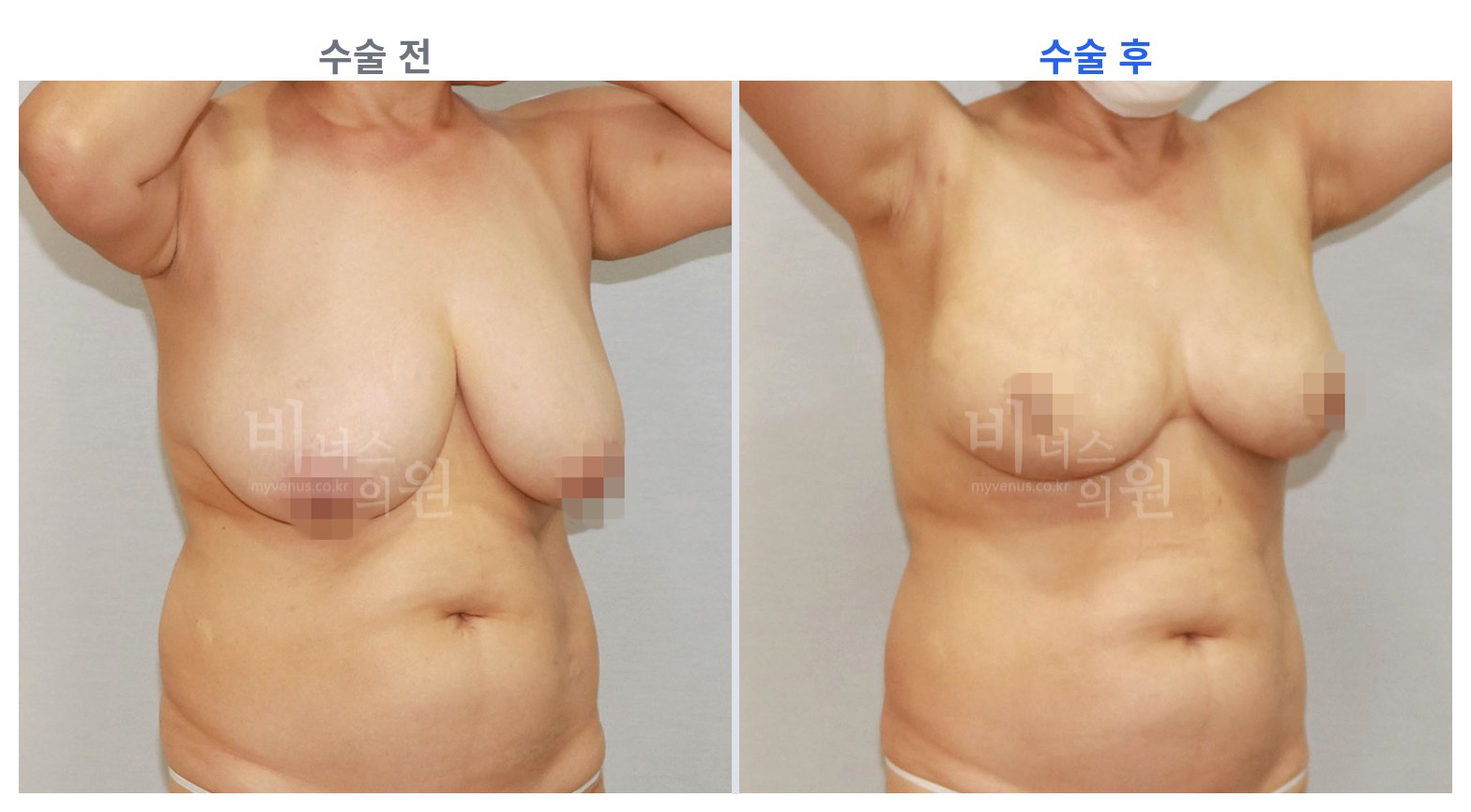 유방하수 표층 지방흡입 45도 전후 비교 왼쪽 수술 전 오른쪽 수술 후