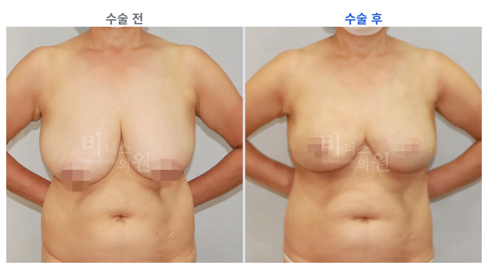 유방하수 표층 지방흡입 정면 전후 비교 왼쪽 수술 전 오른쪽 수술 후