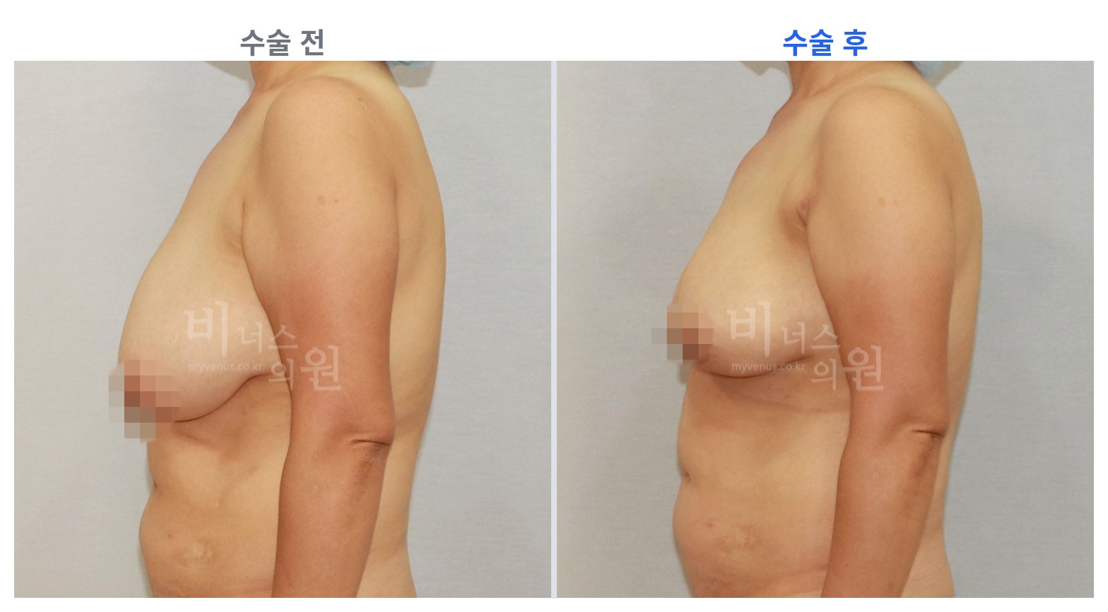 유방하수 표층 지방흡입 측면 전후 비교 왼쪽 수술 전 오른쪽 수술 후