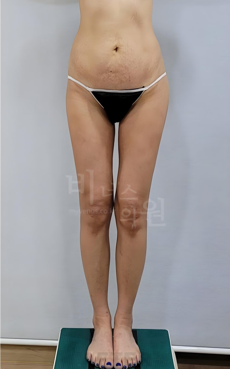 엉덩이축소 지방흡입, 수술 당일부터 6개월까지 — 시기별로 정리한 회복의 기록