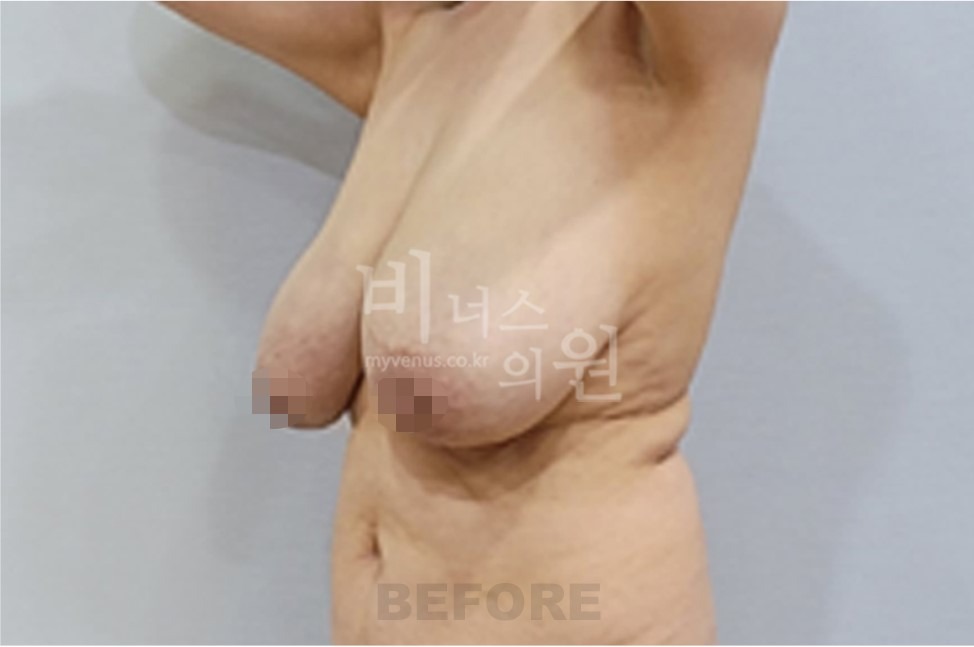 유방처짐 지방흡입 수술 전 45도 사진