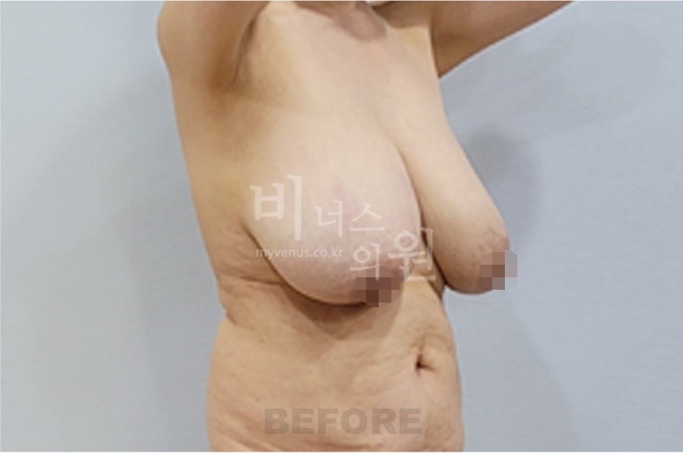 유방처짐 지방흡입 수술 전 반대쪽 45도 사진