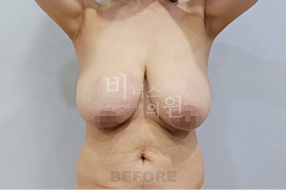 유방처짐 지방흡입 수술 전 정면 사진