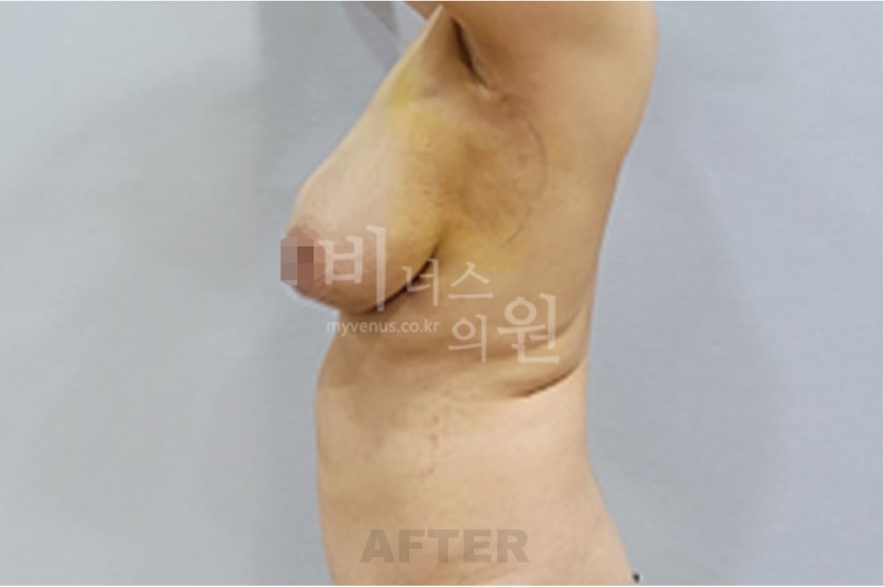 유방처짐 지방흡입 수술 후 측면 사진