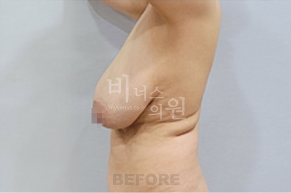 유방처짐 지방흡입 수술 전 측면 사진