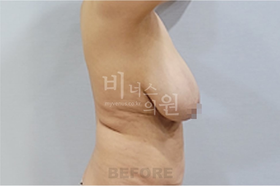 유방처짐 지방흡입 수술 전 반대쪽 측면 사진