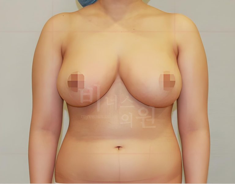 운동할 때마다 흔들림이 신경 쓰였던 가슴, 유방하수 표층 지방흡입 회복 과정을 따라가 보니