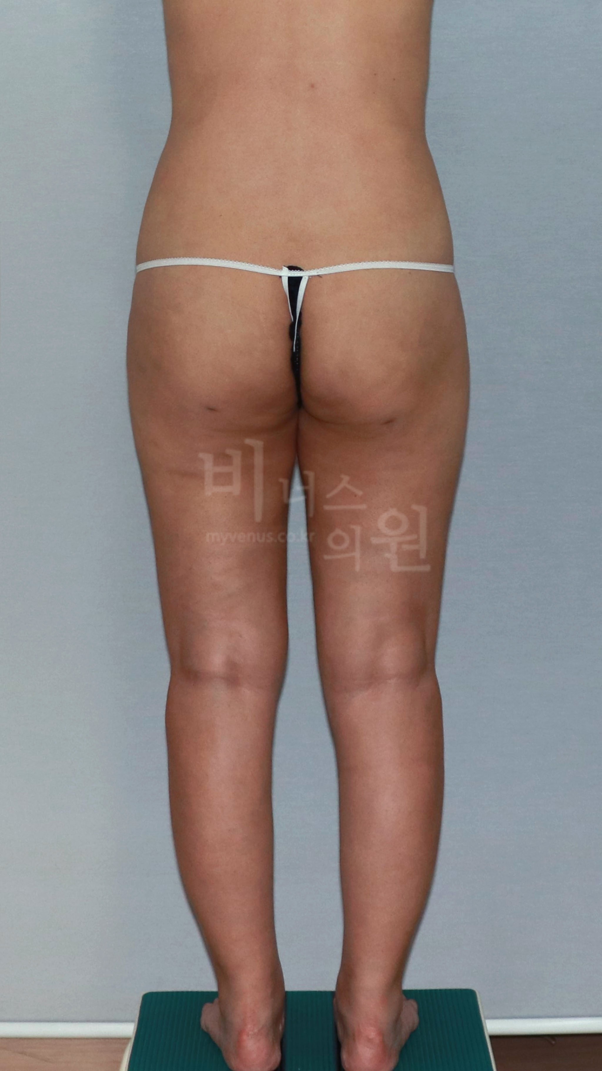 엉덩이 부위 사례 사진 4 (후면)