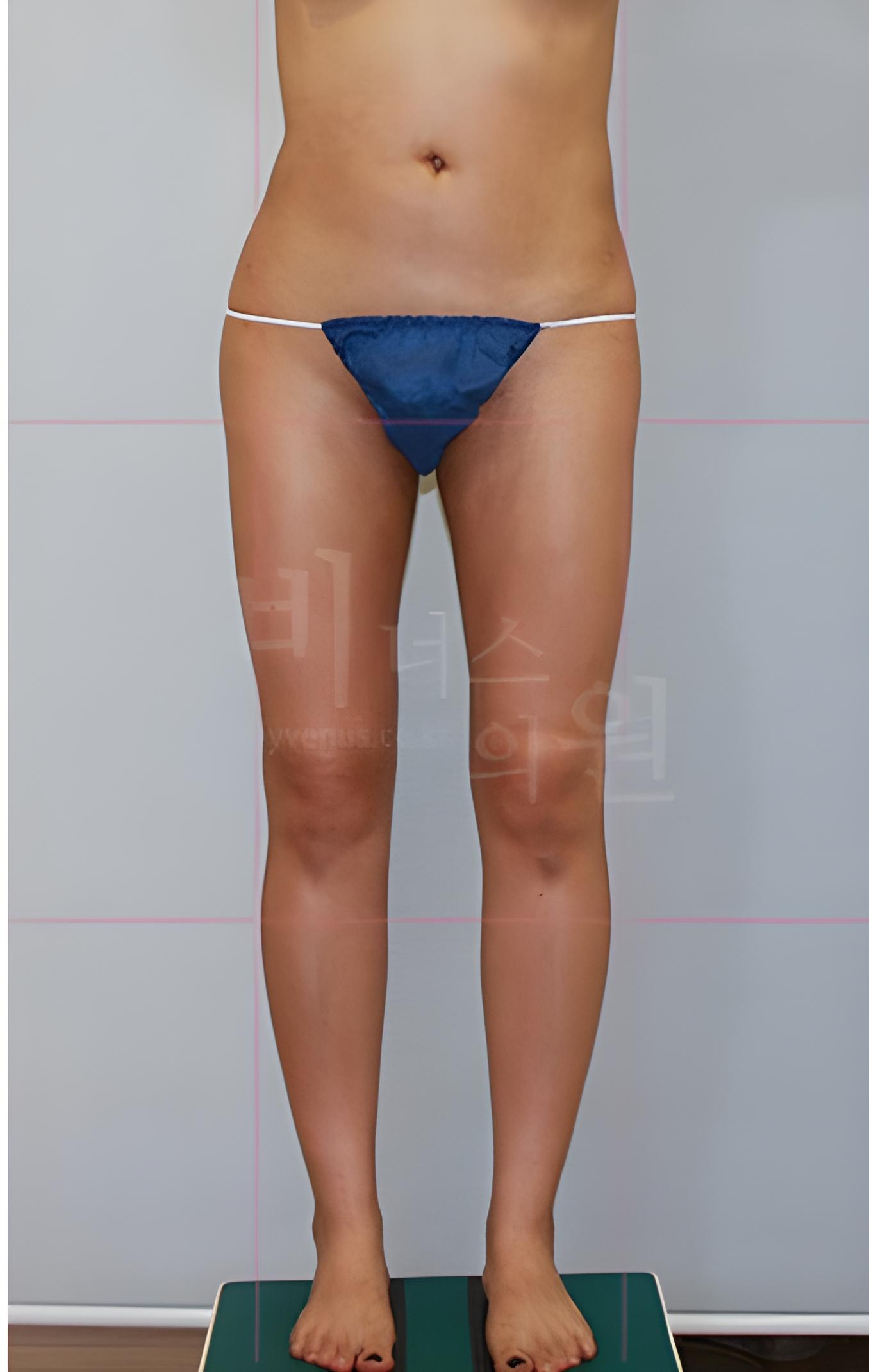 엉덩이처짐 표층 지방흡입 수술 후 정면