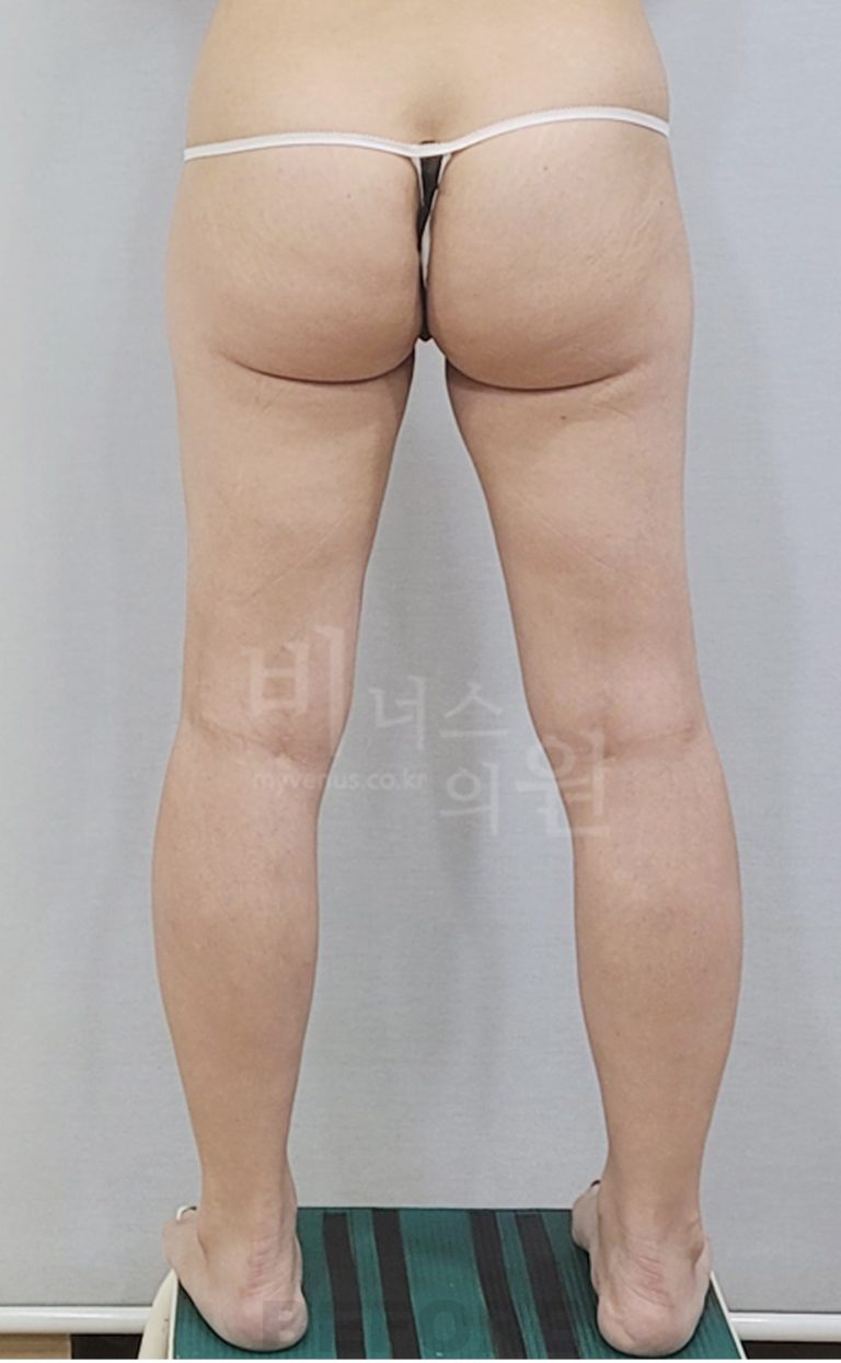 엉덩이축소 지방흡입 수술 전 후면 사진 다리 벌림 자세