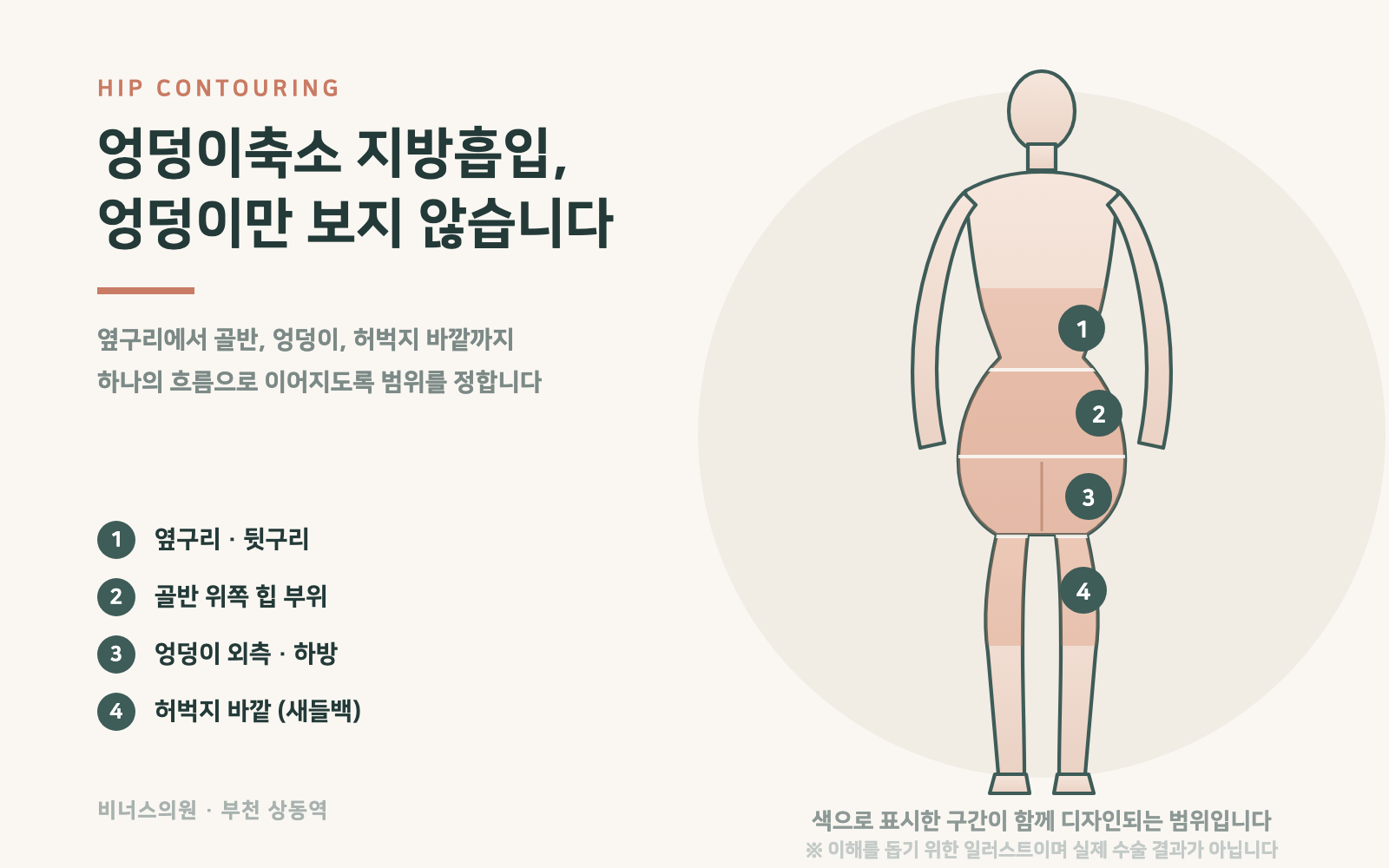 엉덩이축소 지방흡입 시술 범위를 표시한 참고 일러스트, 엉덩이 외곽과 하방 라인