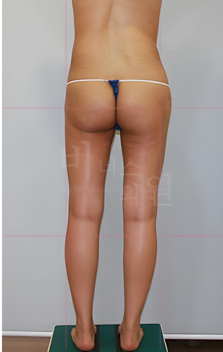 엉덩이축소 지방흡입, 상담실 문을 열기까지 — 망설임과 결심 사이