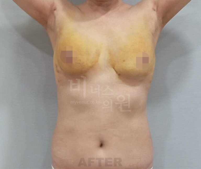 요가복과 수영복 앞에서 망설여졌던 이유 — 유방처짐 표층 지방흡입 회복 이야기