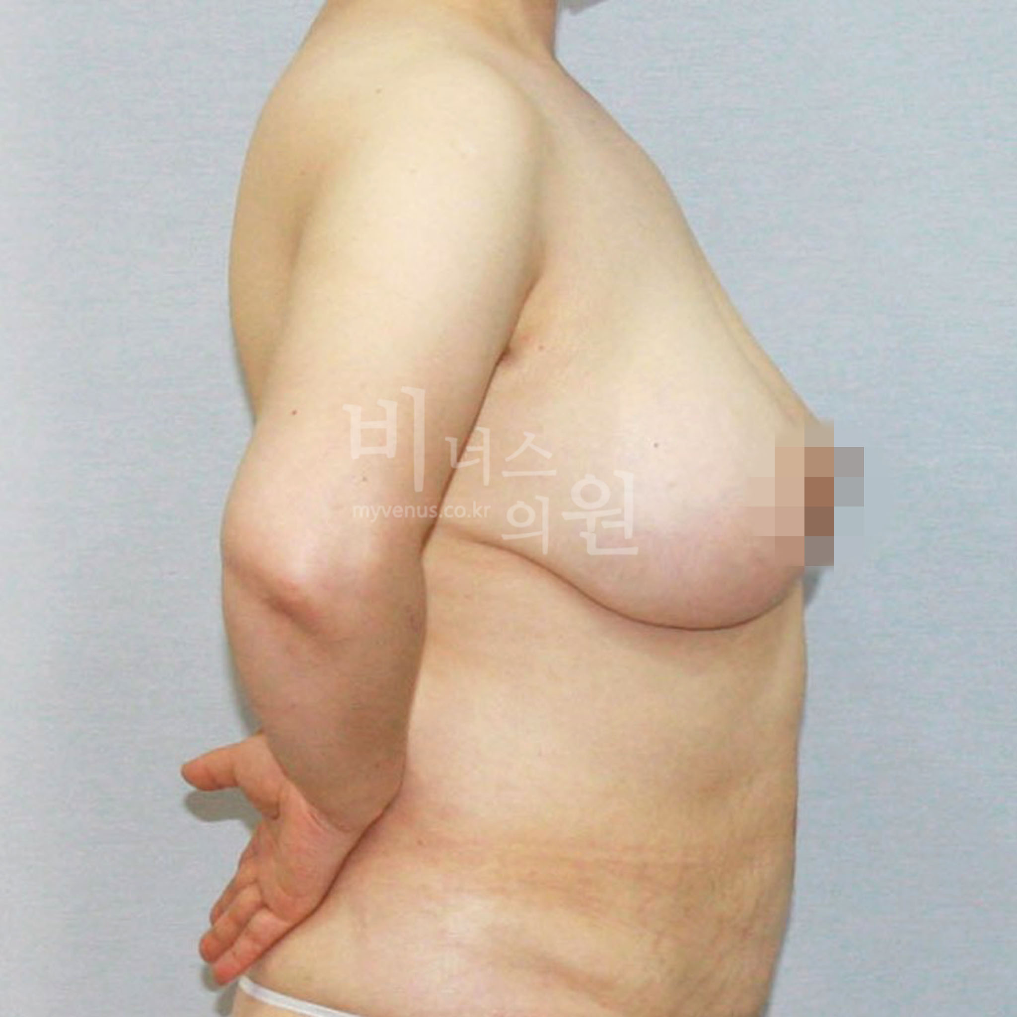 비너스의원 표층 지방흡입 사례 사진 5