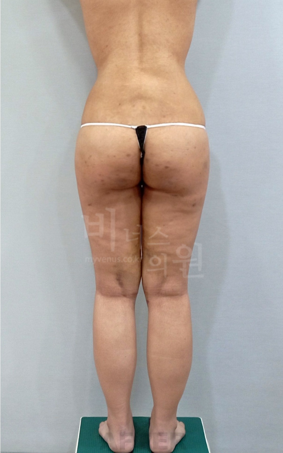 엉덩이축소 지방흡입 수술 후 후면 사진 - 콤팩트하게 정리된 힙 폭