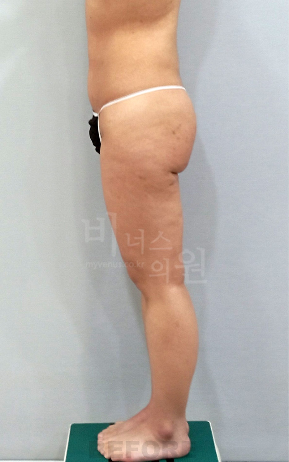 엉덩이축소 지방흡입 수술 전 측면 사진 - 힙 하단 볼륨