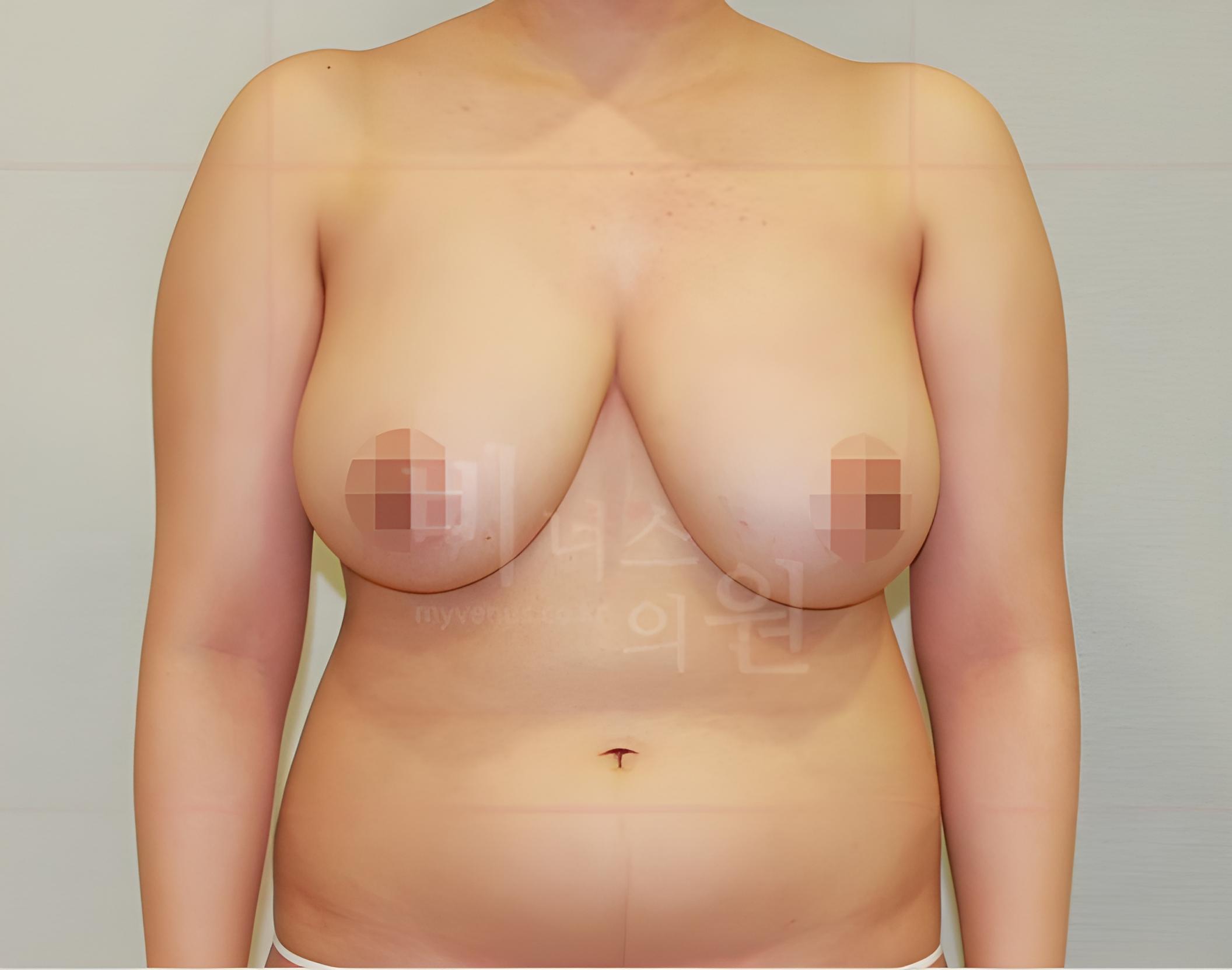 유방하수 표층 지방흡입 전후 참고용 정면 수술 전 사진 비너스의원