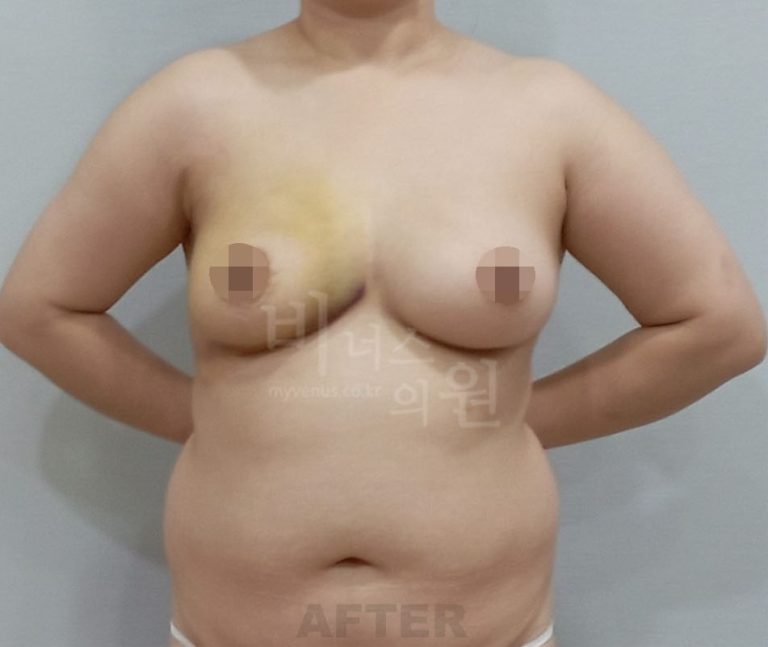 유방처짐 표층 지방흡입 수술 후 정면 사진