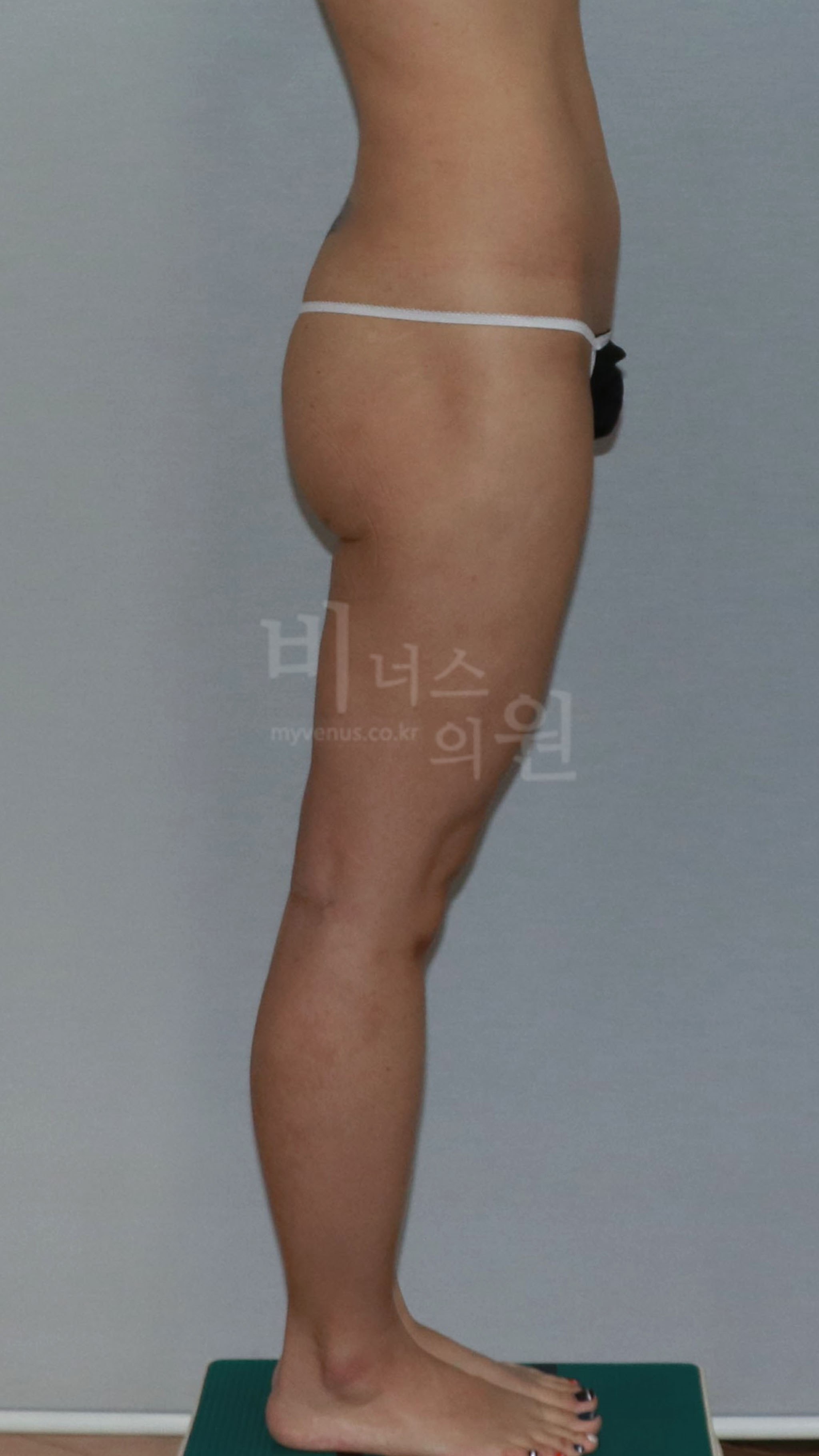 엉덩이 라인 수술 전 측면 비교 2 사진
